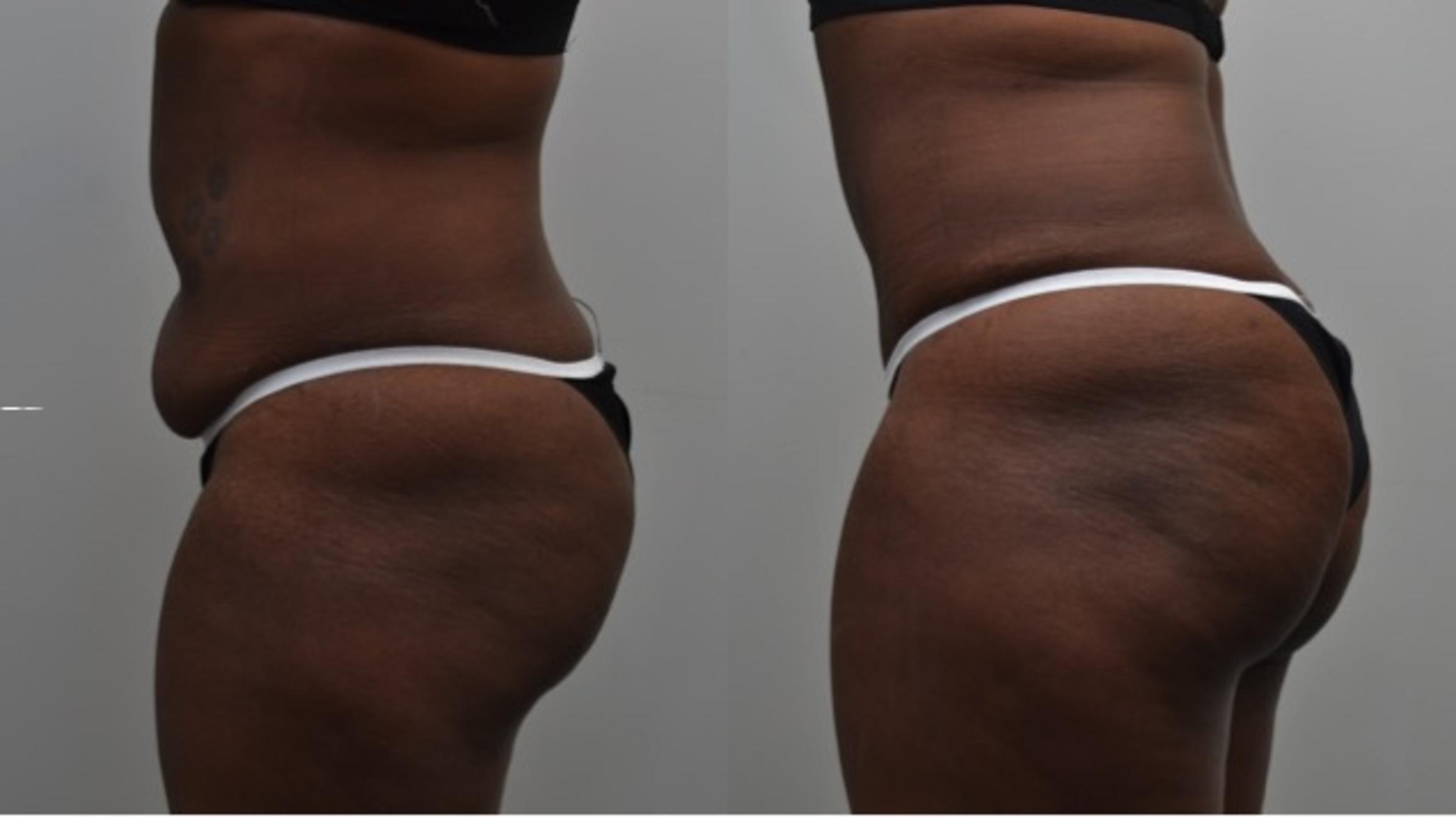 Liposuction procedure